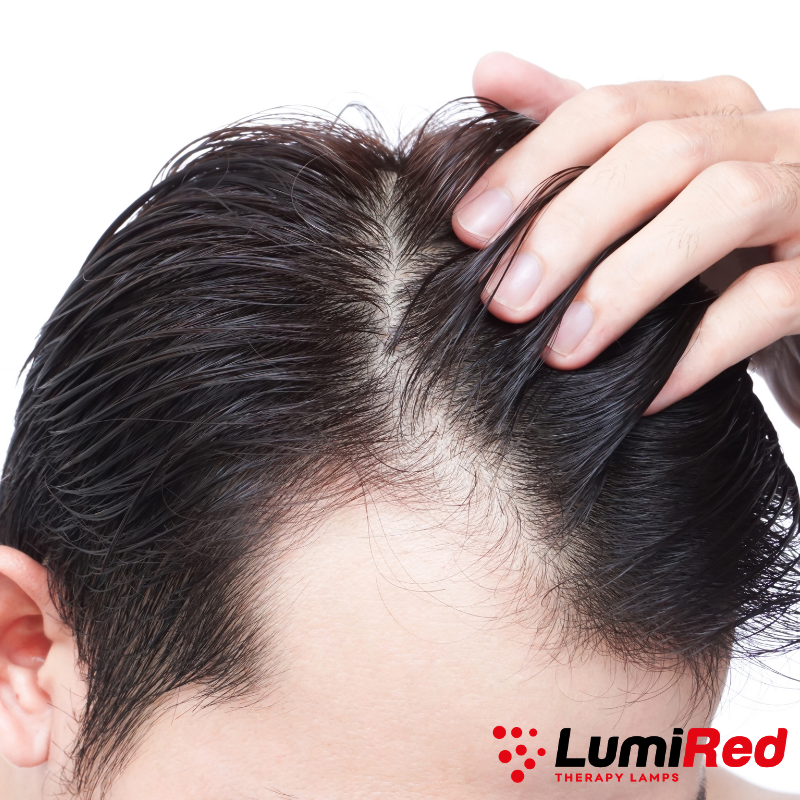 Does Red Light Therapy Work For Hair Loss?