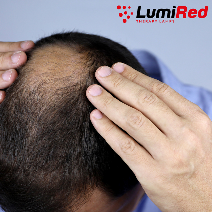 The Illuminating Truth: Red Light Therapy and its Profound Impact on Hair Growth